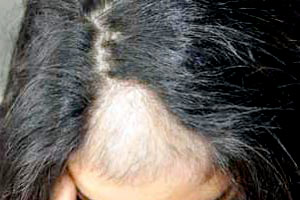 Perte de cheveux chez la femme à Genève - Centre Dermatologie Cornavin